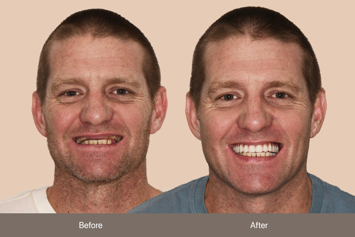BEFORE & AFTER_Anthony F_WOL (3)
