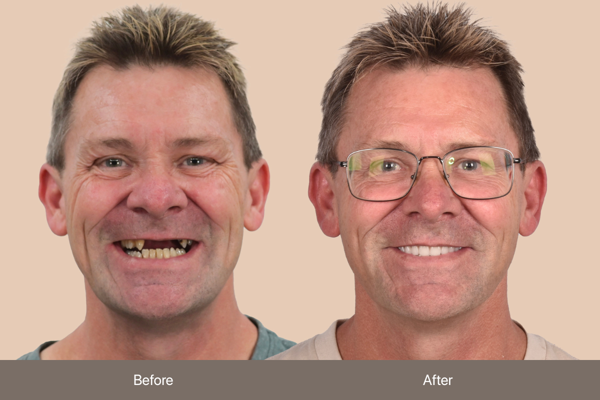 BEFORE & AFTER_Philip Harold_MEL (3)
